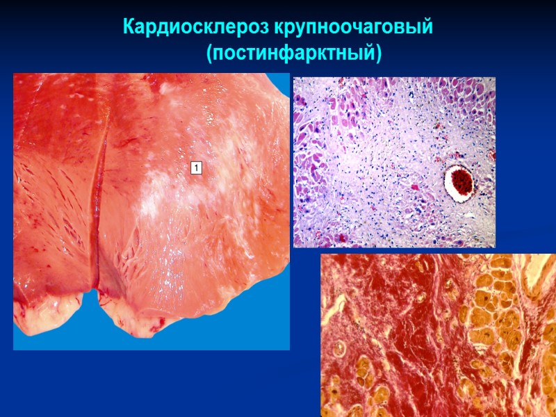 Кардиосклероз крупноочаговый        (постинфарктный)